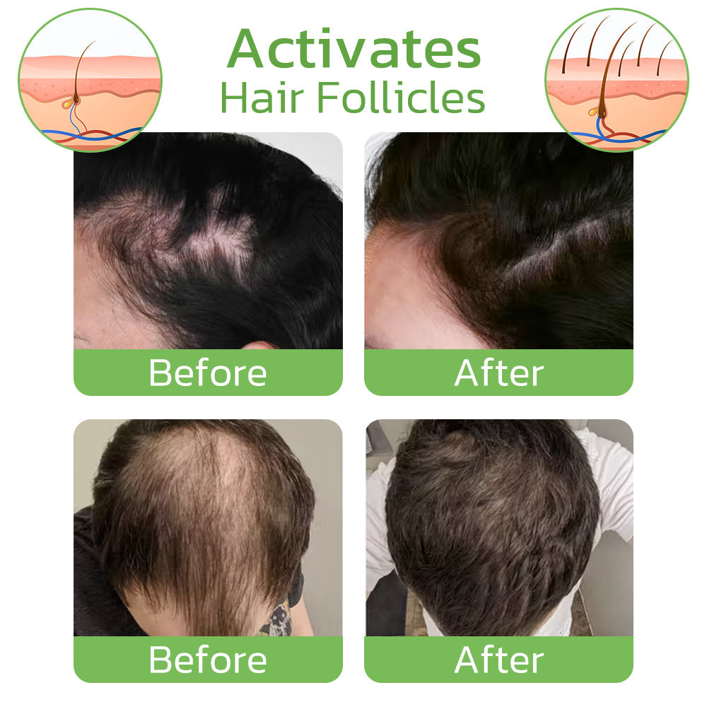 GroeiEssentie Haarwachstum Spray – Ingwer Minoxidil Haarspray gegen Haarausfall