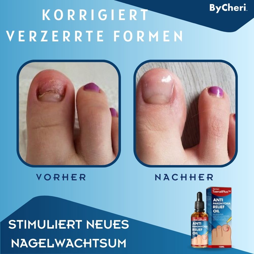 HeilungsTropfen™ - Beschädigte Nägel in 4 Wochen wiederherstellen [1 + 1 Gratis]