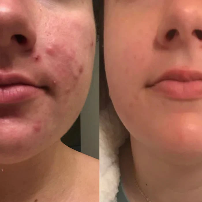 Skinmend™ – Narbenbehandlungstücher für Strahlende Haut | 1 + 1 Gratis
