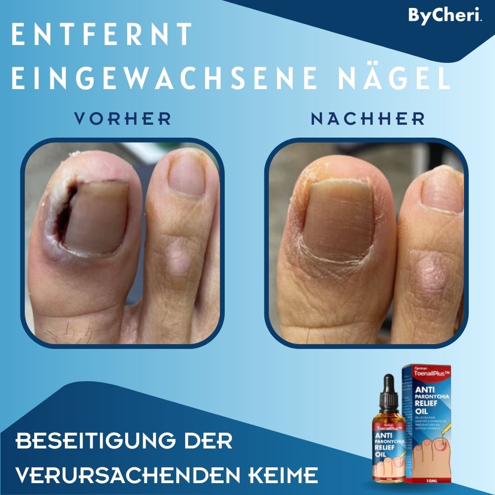 HeilungsTropfen™ - Beschädigte Nägel in 4 Wochen wiederherstellen [1 + 1 Gratis]