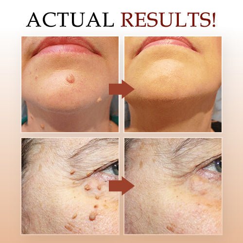 WipeOff Remover – Hautanhängsel & Warzen sanft und narbenfrei entfernen