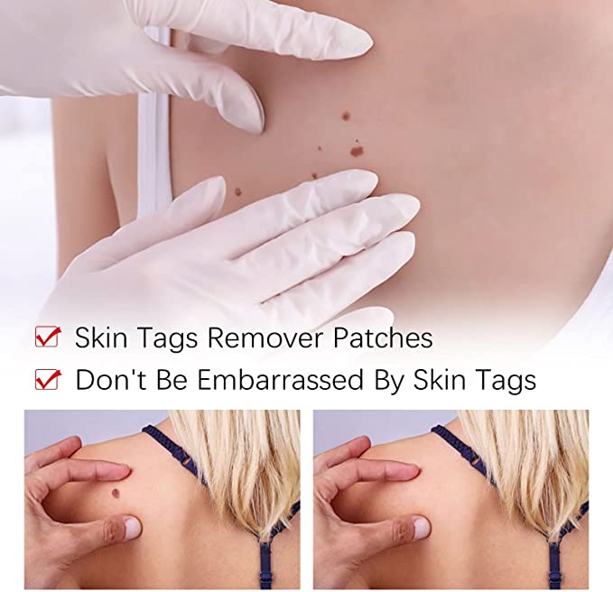 WipeOff Remover – Hautanhängsel & Warzen sanft und narbenfrei entfernen