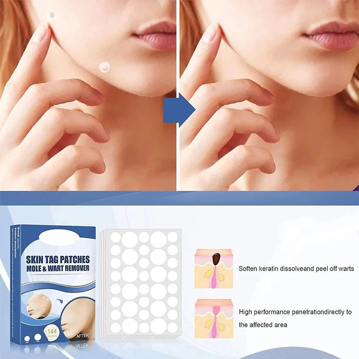 TagAway™ – Pflaster zur Entfernung von Hautanhängern und Warzen | 50% Rabatt