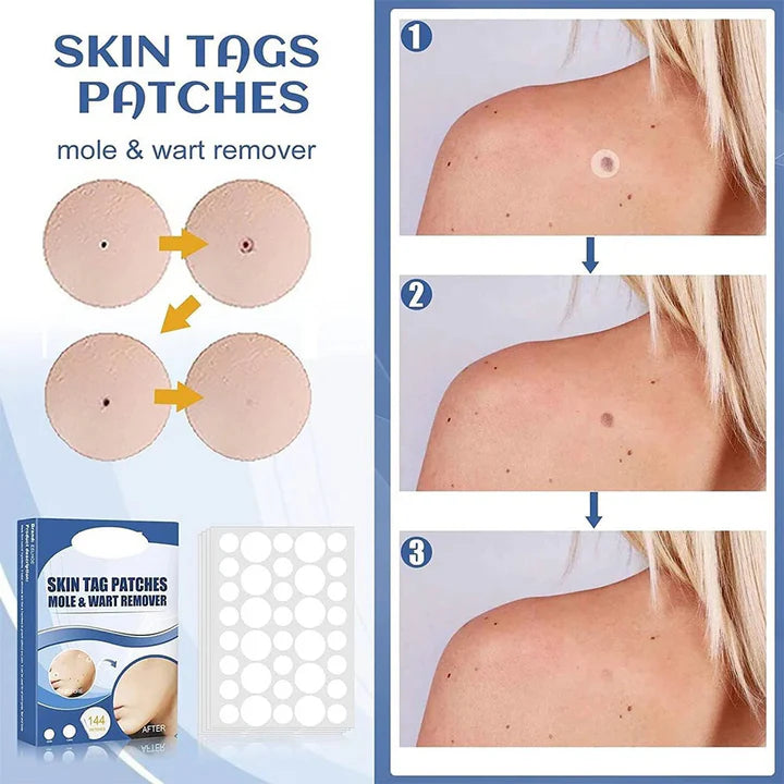 TagAway™ – Pflaster zur Entfernung von Hautanhängern und Warzen | 50% Rabatt