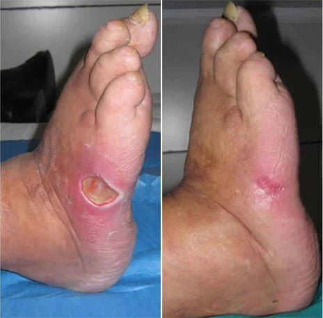 GlucoHeal™ – Spendet Feuchtigkeit und schützt [50% Rabatt]