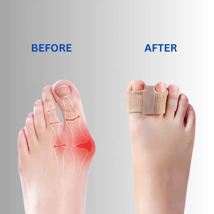 ToeCorrect™ – Sanfte Korrektur von Hallux & überlappenden Zehen [2 + 2 Gratis]